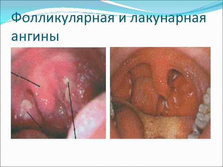Фолликулярная и лакунарная ангины 