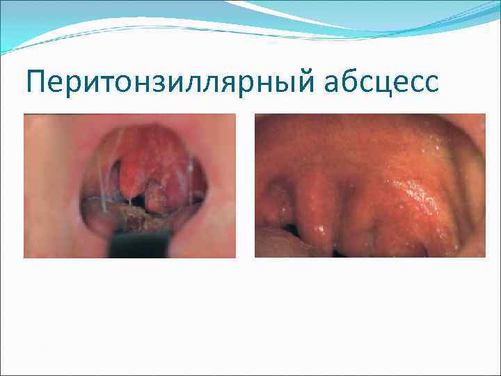 Перитонзиллярный абсцесс 