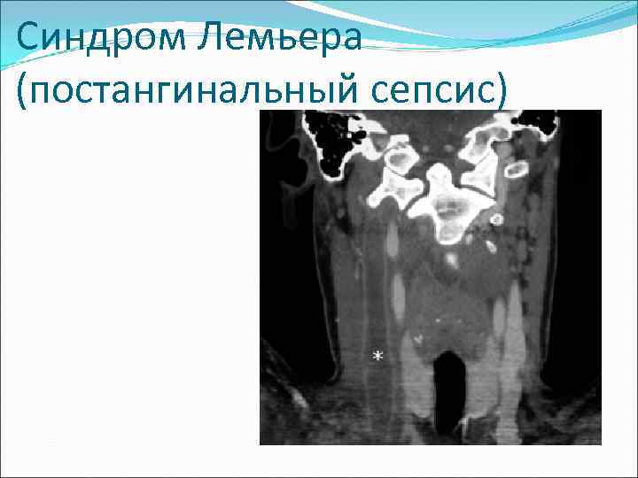 Синдром Лемьера (постангинальный сепсис) 