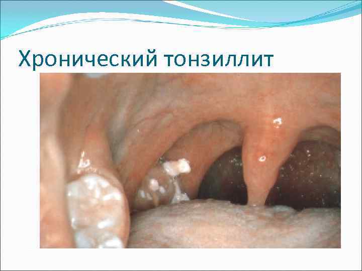 Хронический тонзиллит 