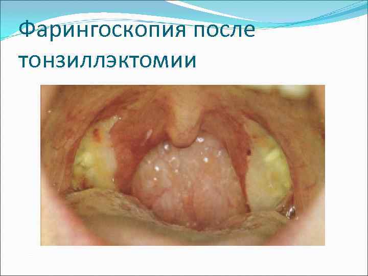 Фарингоскопия после тонзиллэктомии 