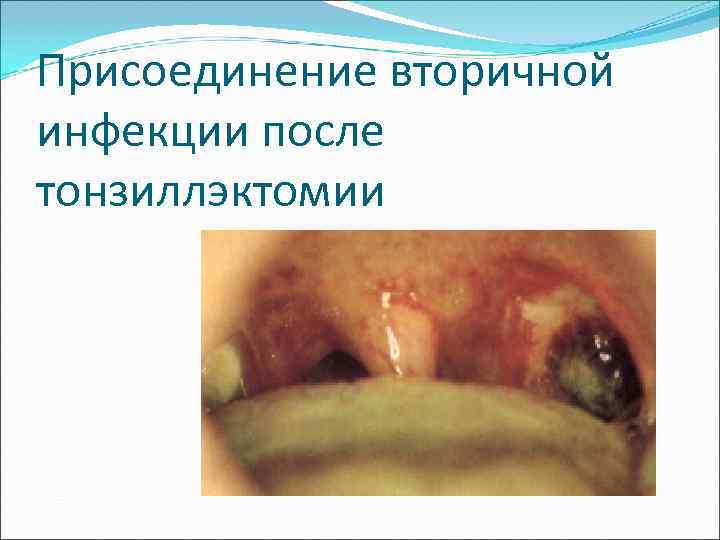 Присоединение вторичной инфекции после тонзиллэктомии 