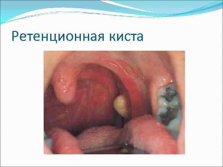 Ретенционная киста 