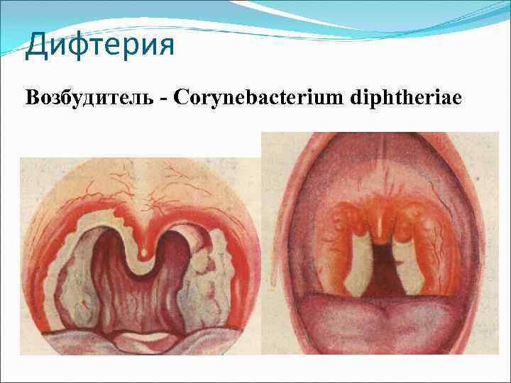 Дифтерия Возбудитель - Corynebacterium diphtheriae 