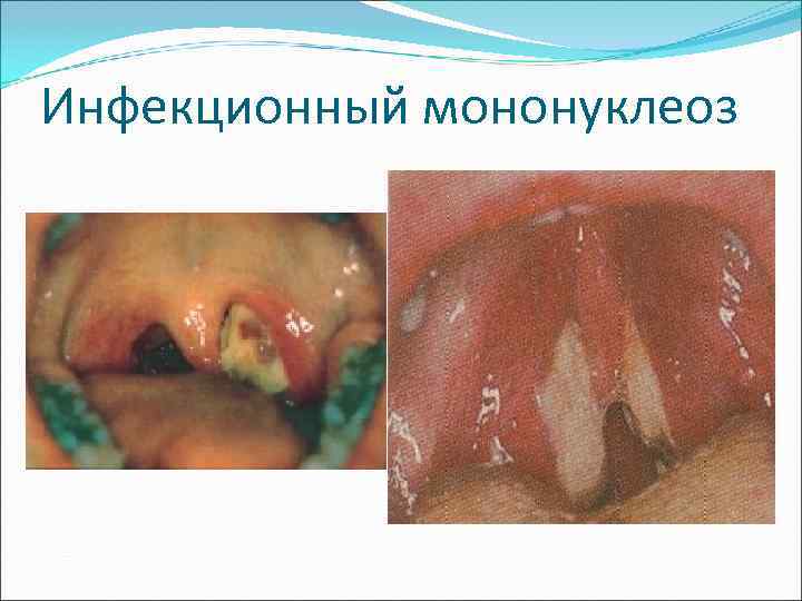 Инфекционный мононуклеоз 
