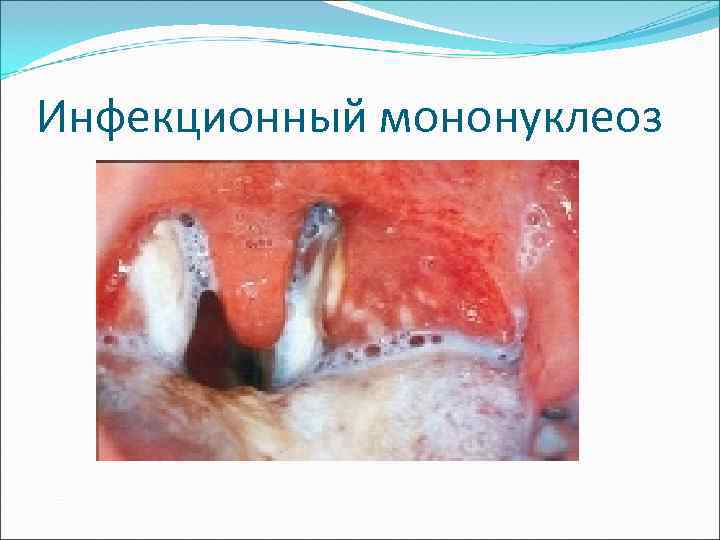 Инфекционный мононуклеоз 
