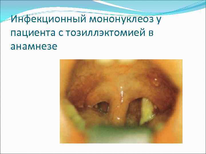 Инфекционный мононуклеоз у пациента с тозиллэктомией в анамнезе 