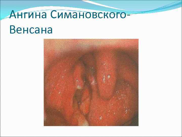 Ангина Симановского- Венсана 