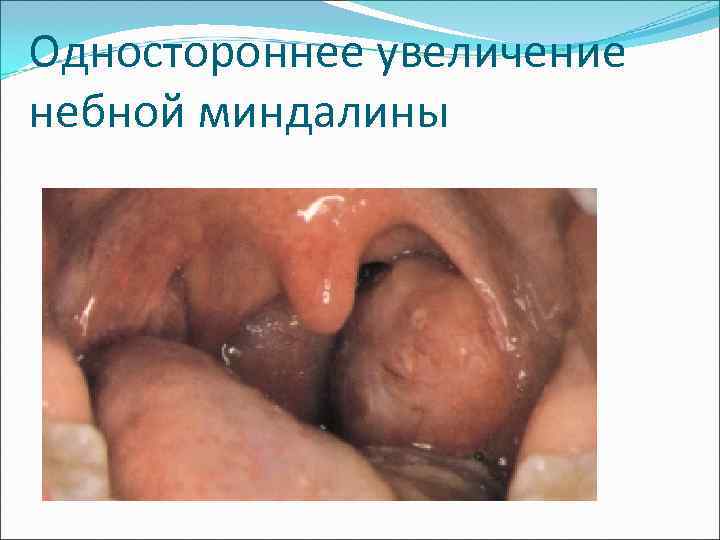 Одностороннее увеличение небной миндалины 