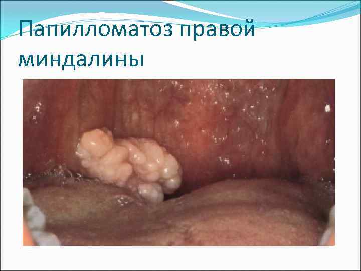 Папилломатоз правой миндалины 