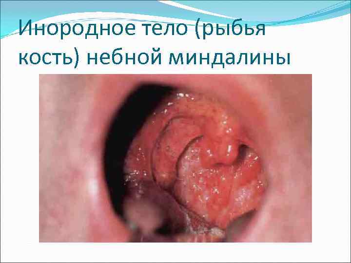 Инородное тело (рыбья кость) небной миндалины 