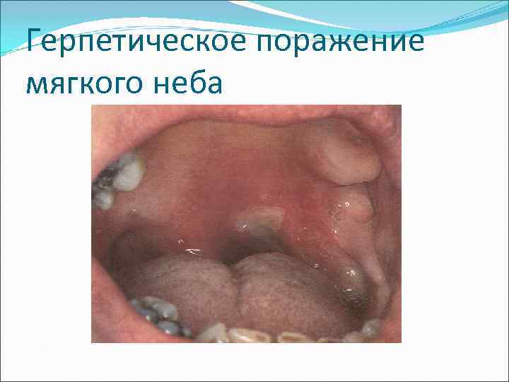 Герпетическое поражение мягкого неба 