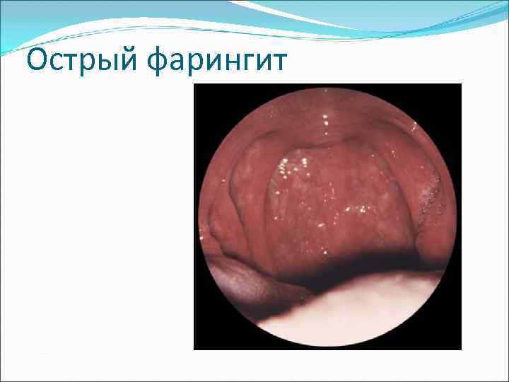 Острый фарингит 