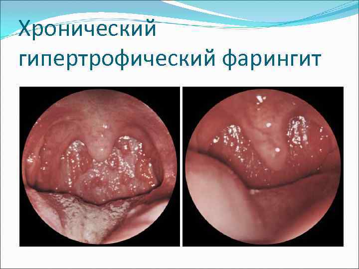 Хронический гипертрофический фарингит 
