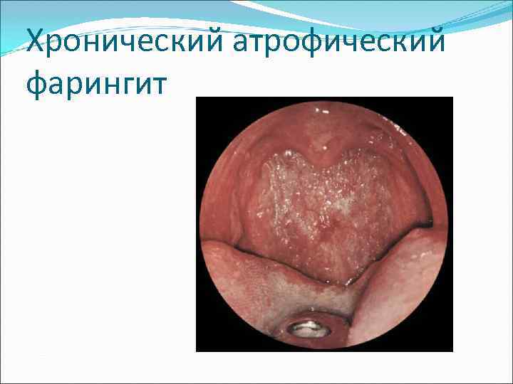 Хронический атрофический фарингит 