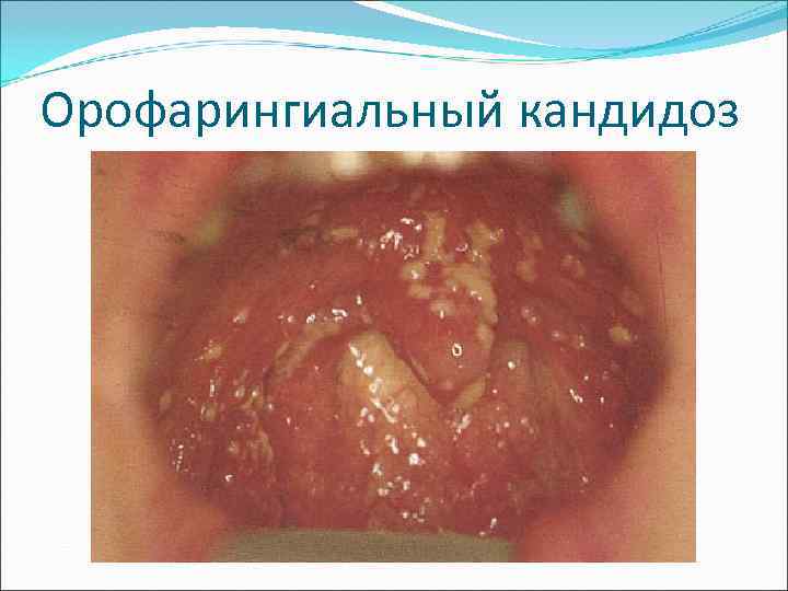 Орофарингиальный кандидоз 
