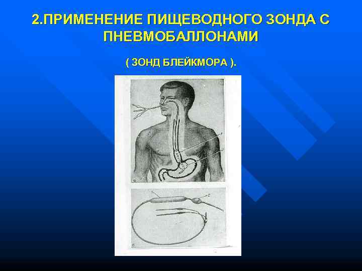 2. ПРИМЕНЕНИЕ ПИЩЕВОДНОГО ЗОНДА С   ПНЕВМОБАЛЛОНАМИ  ( ЗОНД БЛЕЙКМОРА ). 