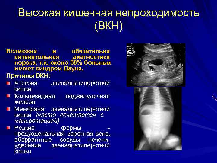 Врожденная низкая кишечная непроходимость презентация