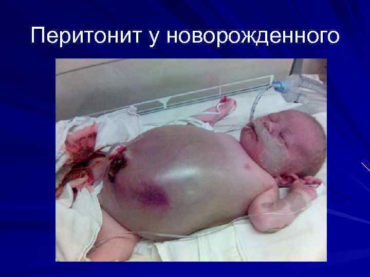 Перитонит у новорожденного 