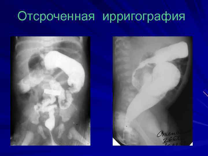 Отсроченная ирригография 