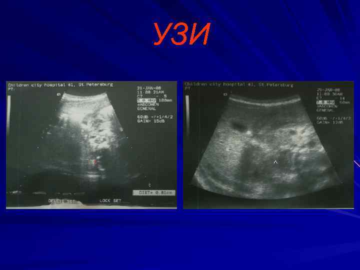   УЗИ  ^ 