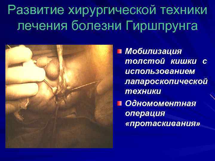 Развитие хирургической техники  лечения болезни Гиршпрунга   Мобилизация   толстой кишки