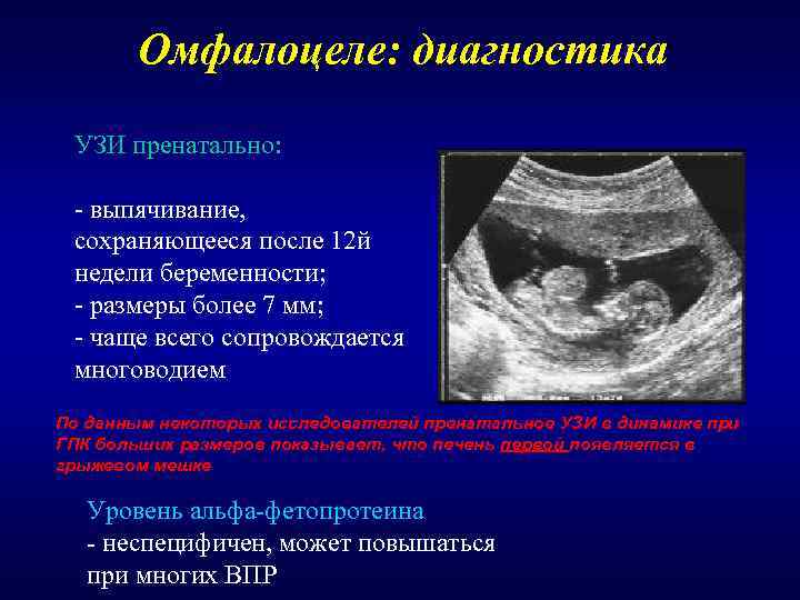   Омфалоцеле: диагностика  УЗИ пренатально:  - выпячивание,  сохраняющееся после 12