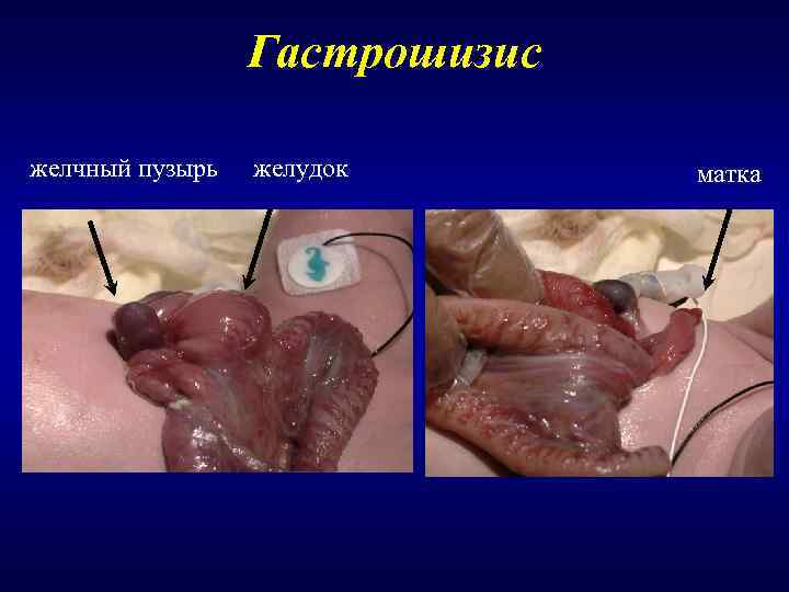    Гастрошизис желчный пузырь  желудок  матка 