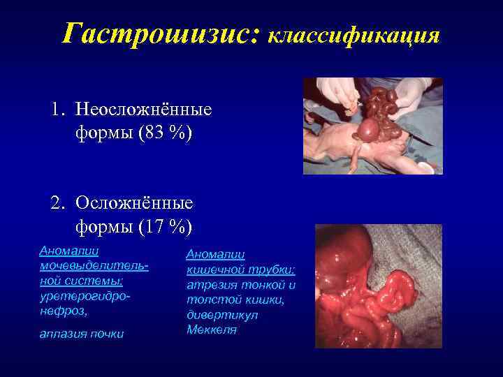   Гастрошизис: классификация  1. Неосложнённые формы (83 %)  2. Осложнённые формы