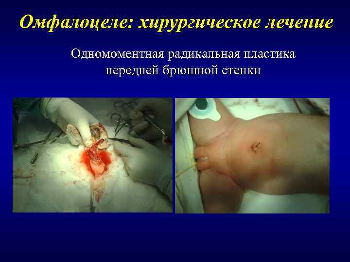 Омфалоцеле: хирургическое лечение Одномоментная радикальная пластика   передней брюшной стенки 