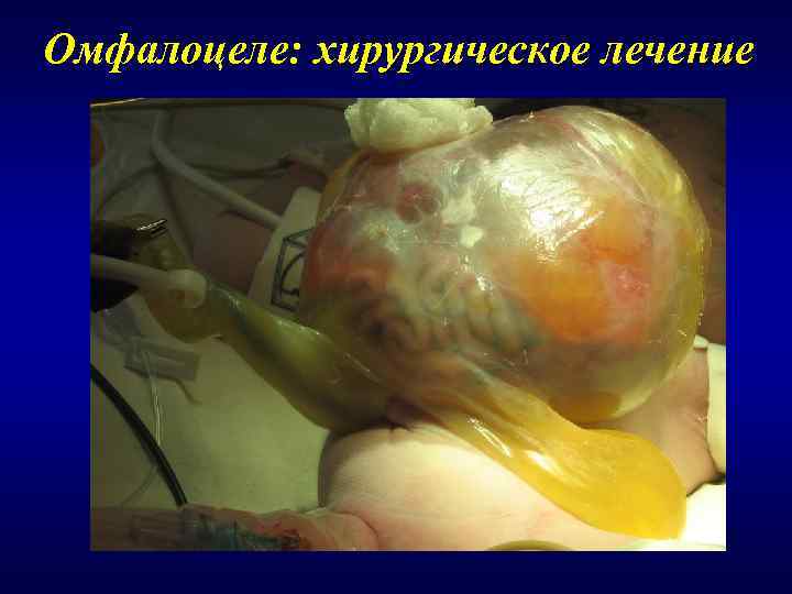 Омфалоцеле: хирургическое лечение 