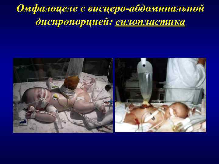 Омфалоцеле с висцеро-абдоминальной  диспропорцией: силопластика 