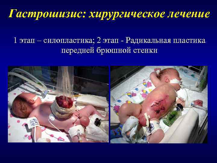 Гастрошизис: хирургическое лечение 1 этап – силопластика; 2 этап - Радикальная пластика  