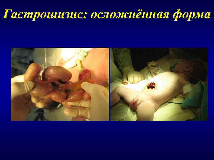 Гастрошизис: осложнённая форма 