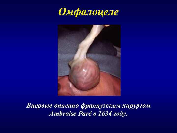    Омфалоцеле Впервые описано французским хирургом  Ambroise Paré в 1634 году.