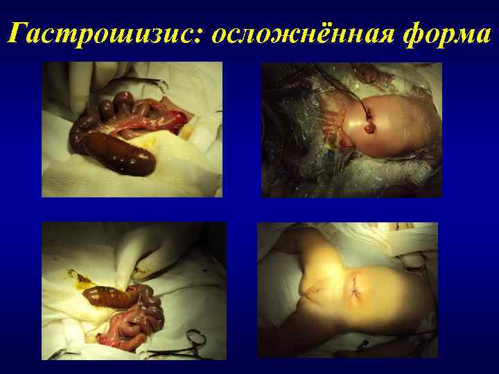 Гастрошизис: осложнённая форма 