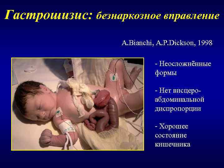 Гастрошизис: безнаркозное вправление    A. Bianchi, A. P. Dickson, 1998  