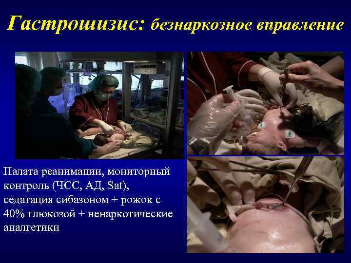 Гастрошизис: безнаркозное вправление Палата реанимации, мониторный контроль (ЧСС, АД, Sat), седатация сибазоном + рожок