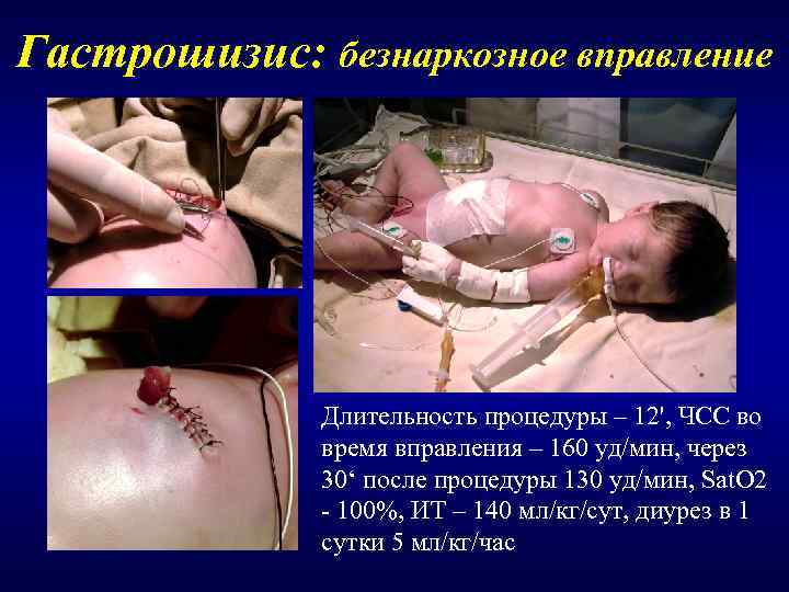 Гастрошизис: безнаркозное вправление    Длительность процедуры – 12', ЧСС во  