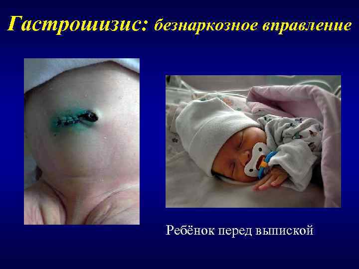 Гастрошизис: безнаркозное вправление     Ребёнок перед выпиской 