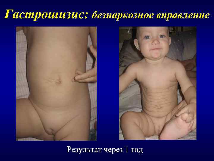 Гастрошизис: безнаркозное вправление    Результат через 1 год 