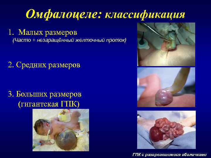  Омфалоцеле: классификация 1. Малых размеров (Часто + незаращённый желточный проток)  2. Средних
