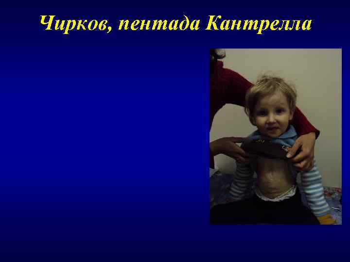 Чирков, пентада Кантрелла 