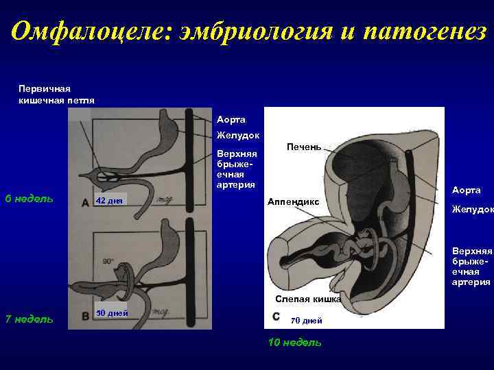 Омфалоцеле: эмбриология и патогенез  Первичная  кишечная петля     