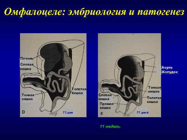 Омфалоцеле: эмбриология и патогенез  Печень  Слепая  кишка    Аорта
