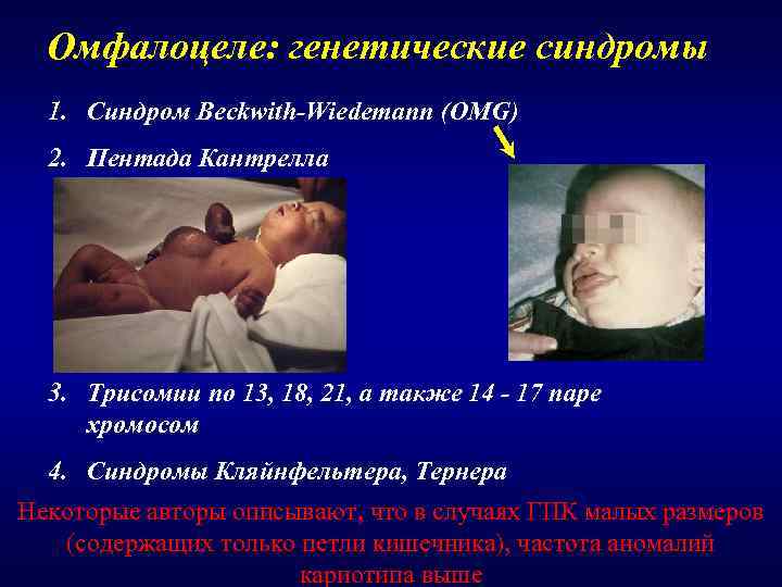  Омфалоцеле: генетические синдромы  1. Синдром Beckwith-Wiedemann (OMG)  2. Пентада Кантрелла 