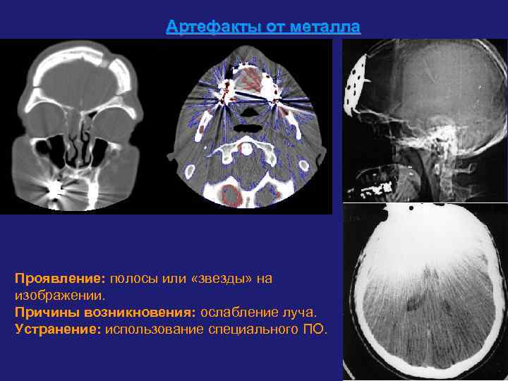     Артефакты от металла Проявление: полосы или «звезды» на изображении. Причины