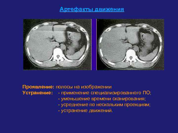    Артефакты движения Проявление: полосы на изображении Устранение: - применение специализированного ПО;