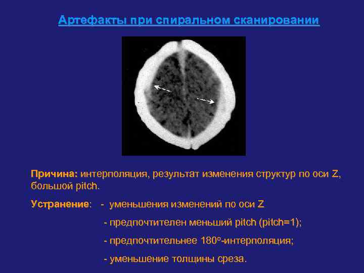  Артефакты при спиральном сканировании Причина: интерполяция, результат изменения структур по оси Z, большой