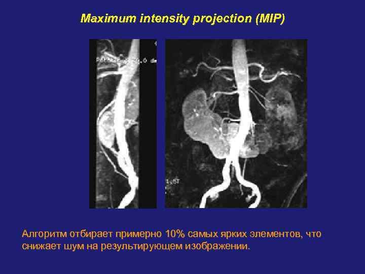   Maximum intensity projection (MIP) Алгоритм отбирает примерно 10% самых ярких элементов, что